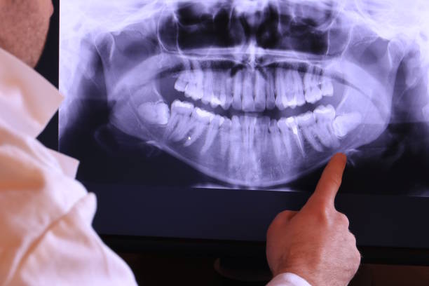 Best Emergency Root Canal Treatment in Burt, MI